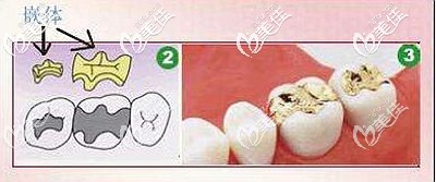 嵌體補(bǔ)牙的優(yōu)勢和原理 嵌體補(bǔ)牙的優(yōu)勢和原理