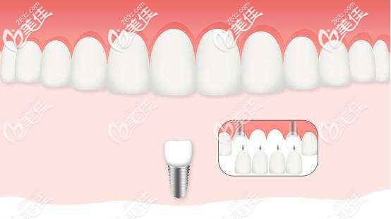 缺4顆牙種兩顆種植牙圖片 缺4顆牙種兩顆種植牙圖片