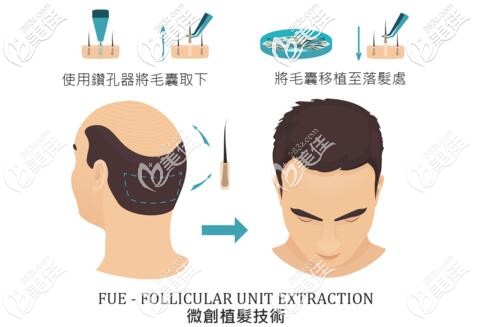 晏醫(yī)生做微創(chuàng)植發(fā)技術(shù)的手術(shù)示意圖 晏醫(yī)生做微創(chuàng)植發(fā)技術(shù)的手術(shù)示意圖