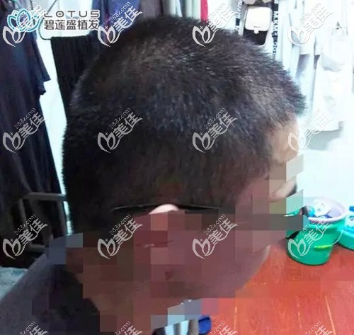 24歲小程遭遇M型脫發(fā)和男性斑禿，抱著試一試的態(tài)度做了植發(fā)結(jié)果......