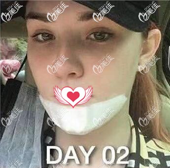 在泰國藝術(shù)整形外科做假體墊下巴術(shù)后第2天