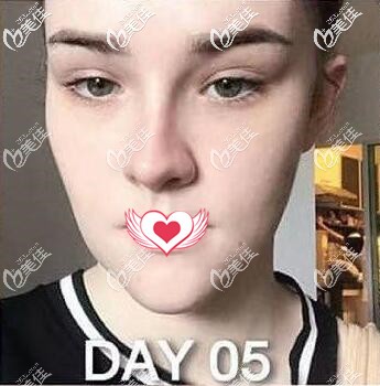 硅膠假體墊下巴術(shù)后第5天恢復(fù)效果