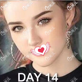 在泰國做假體墊下巴術(shù)后14天恢復(fù)效果圖