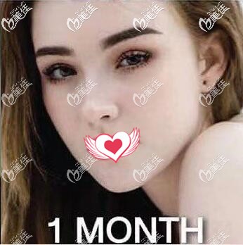 講真的我在泰國藝術整形外科做假體墊下巴不僅價格便宜而且效果也很不錯，很自然！