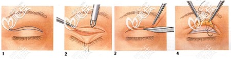 全切雙眼皮手術的原理 全切雙眼皮手術的原理