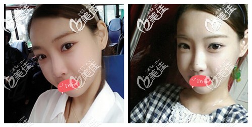 內(nèi)雙割雙眼皮后恢復(fù)過程雖然有點難熬，但是看到40天恢復(fù)圖覺得很欣慰