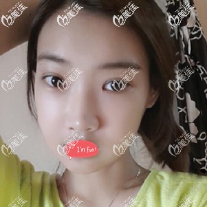 切開雙眼皮術后1個月完全消腫 切開雙眼皮術后1個月完全消腫