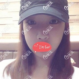 做全切雙眼皮術后20天慢慢消腫 做全切雙眼皮術后20天慢慢消腫