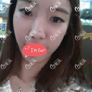 術前是內(nèi)雙眼皮 術前是內(nèi)雙眼皮