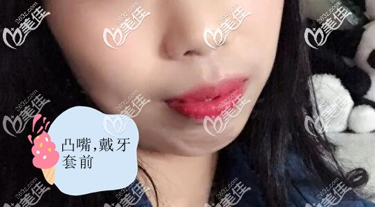 凸嘴戴金屬自鎖牙套前的照片 凸嘴戴金屬自鎖牙套前的照片