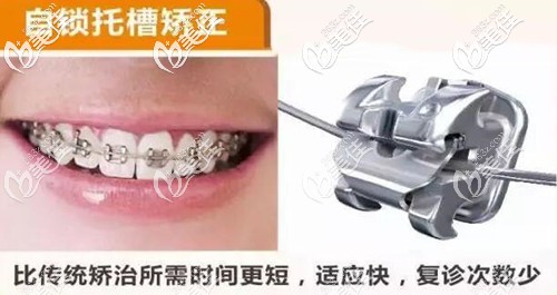 戴金屬自鎖托槽矯正凸嘴 戴金屬自鎖托槽矯正凸嘴