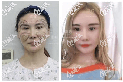 北京喬愛軍面部脂肪填充失敗修復(fù)案例