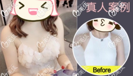 傲諾拉225cc假體隆胸一年后效果圖 傲諾拉225cc假體隆胸一年后效果圖