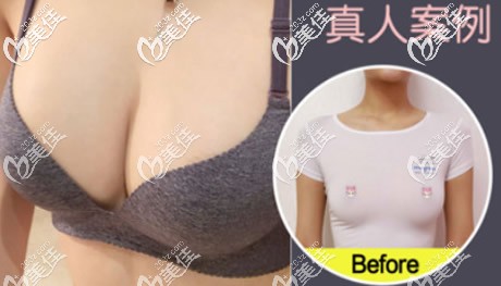 傲諾拉璀璨水滴形225cc假體隆胸6個(gè)月前后對(duì)比照片 傲諾拉璀璨水滴形225cc假體隆胸6個(gè)月前后對(duì)比照片