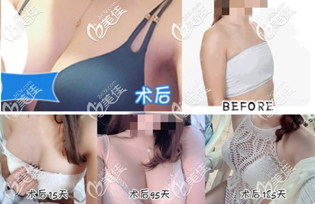曼托假體隆胸前后對比照片 曼托假體隆胸前后對比照片