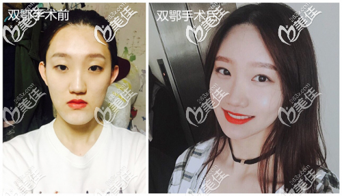 雙鄂手術(shù)前后對(duì)比案例 雙鄂手術(shù)前后對(duì)比案例