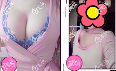 曼托假體隆胸兩年恢復(fù)圖 曼托假體隆胸兩年恢復(fù)圖