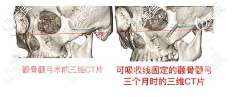 做完微創(chuàng)顴骨顴弓降低術(shù)后三個(gè)月ct圖 做完微創(chuàng)顴骨顴弓降低術(shù)后三個(gè)月ct圖