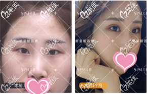 北京新星靚醫(yī)療美容醫(yī)院原生雙眼皮真人案例 北京新星靚醫(yī)療美容醫(yī)院原生雙眼皮真人案例