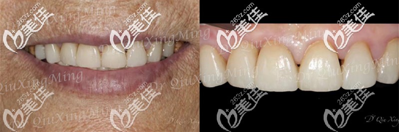 說四環(huán)素牙并不適合貼貼面的，怕是沒看過70歲老人做鑄瓷貼面的案例
