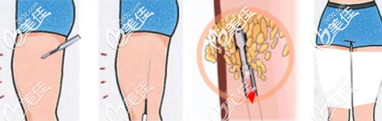 大腿吸脂過程示意圖 大腿吸脂過程示意圖