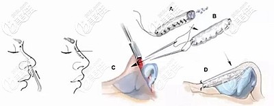 肋軟骨隆鼻的原理