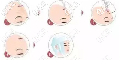 泰國(guó)整形做SMAS除皺術(shù)過(guò)程 泰國(guó)整形做SMAS除皺術(shù)過(guò)程