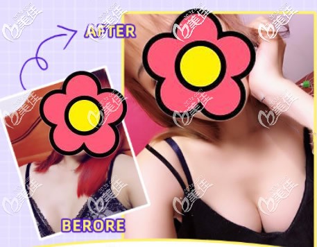 麥格水滴形235假體隆胸一年后效果圖 麥格水滴形235假體隆胸一年后效果圖