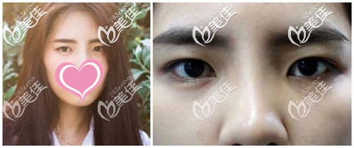 雙眼皮手術(shù)前 雙眼皮手術(shù)前