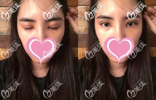 雙眼皮手術(shù)后恢復(fù)一周 雙眼皮手術(shù)后恢復(fù)一周