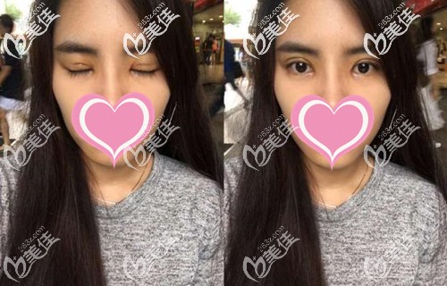 雙眼皮手術(shù)后恢復(fù)半個(gè)月 雙眼皮手術(shù)后恢復(fù)半個(gè)月