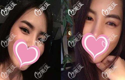 雙眼皮手術(shù)后恢復(fù)半年 雙眼皮手術(shù)后恢復(fù)半年