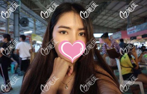 泰國曼谷的馬斯特皮整形做完雙眼皮術后8個月發(fā)現(xiàn)我竟然也可以這么美