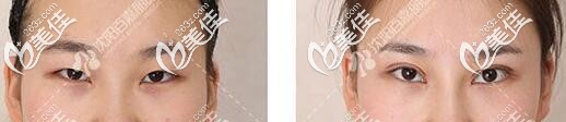 沈陽百嘉麗侯亞杰做雙眼皮真人前后對比案例圖 沈陽百嘉麗侯亞杰做雙眼皮真人前后對比案例圖
