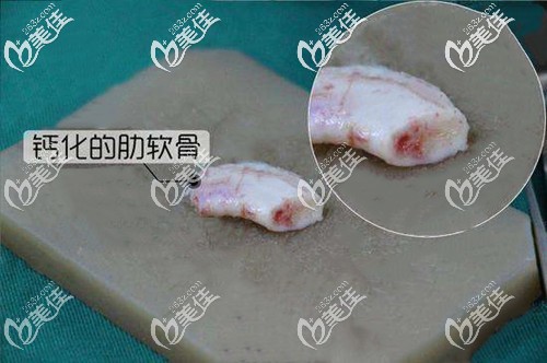 朋友發(fā)給我的鈣化肋軟骨