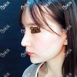 隆鼻術(shù)后12天鼻子挺拔但僵硬