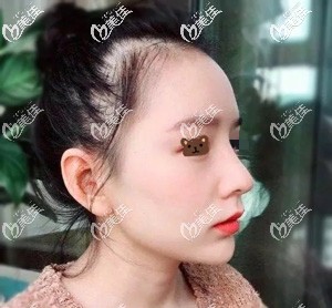 肋軟骨隆鼻30天疤痕漸消