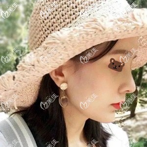 朋友說她做完肋骨鼻半年后鈣化了，而我做完并沒有這種情況究竟是怎么回事呢