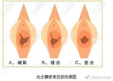 修處手術(shù)后效果對比圖 修處手術(shù)后效果對比圖