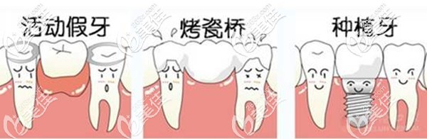 活動(dòng)假牙和烤瓷牙以及種植牙圖解