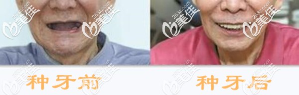 我在鄭州金水區(qū)做全口種植牙效果