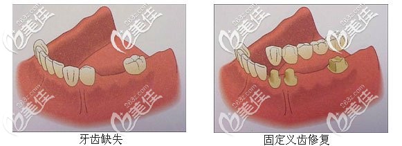 固定義齒修復(fù) 固定義齒修復(fù)