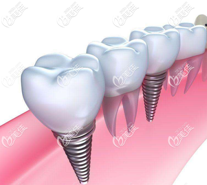 種植牙外觀示意圖 種植牙外觀示意圖