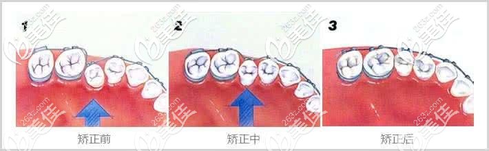牙齒矯正過(guò)程 牙齒矯正過(guò)程