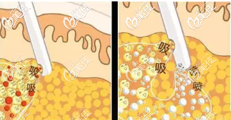 水動(dòng)力吸脂技術(shù)原理 水動(dòng)力吸脂技術(shù)原理