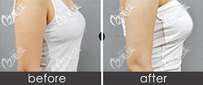 做麥格假體隆胸后的效果對(duì)比