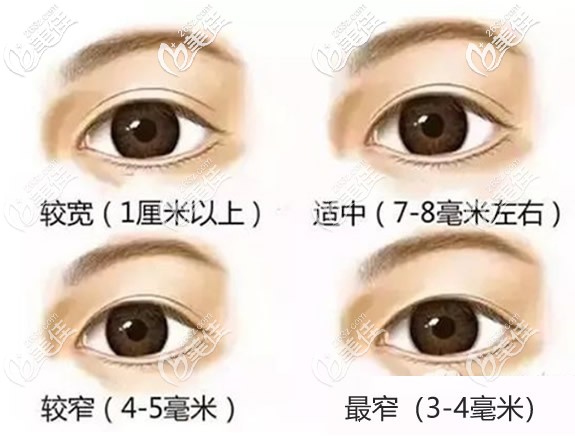 雙眼皮6、7、8毫米恢復(fù)好后的寬度