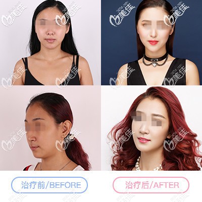 面部脂肪填充對比案例