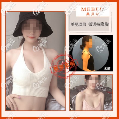 黃名斗傲諾拉假體隆胸案例