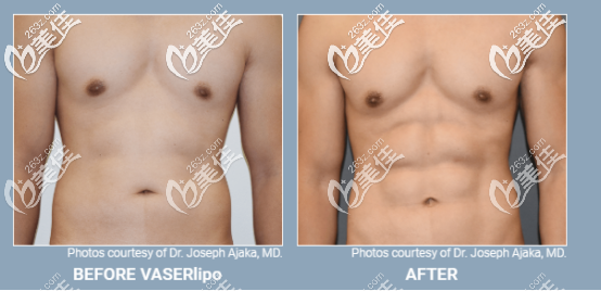 威塑超聲吸脂男性案例